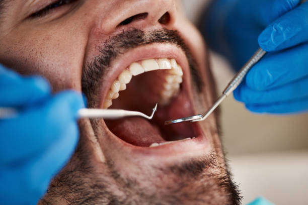 Best Emergency Dentist for Lost Fillings or Crowns in Aledo, TX