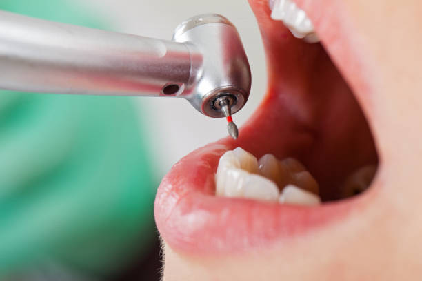 Best Emergency Dentist for Knocked-Out Tooth in Aledo, TX